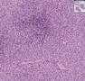 Histopathology Lymph node--Peripheral T-cell lymphoma, unspe
