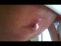 Johannas cyst! For MaryAnn