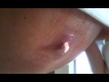Cyst! WARNING EXTREMELY GROSS!!! strong stomachs needed!