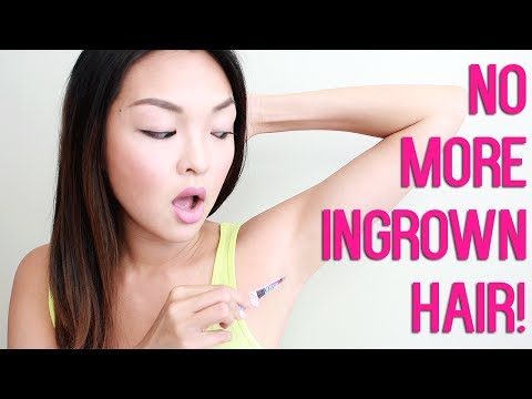 how to get rid of an ingrown hair