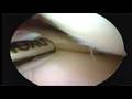 videos de James Key Hole Trimming Ligament