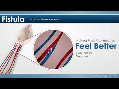 how to care fistula