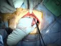 Total Abdominal Hysterectomy: Fibroid Uterus