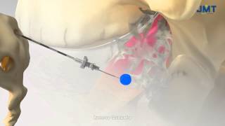 video thumbnail Epidural Catheter System youtube