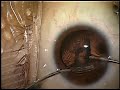 Refractive Lens Exchange Crystalens Surgery Uday Devgan MD Refractive Lens Exchange Crystalens Surgery Uday Devgan MD