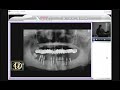 陳俊龍牙醫博士-Trans-Gingival Implants(試看)