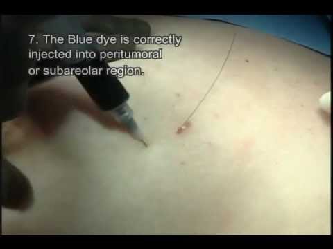 how to perform lymph node biopsy