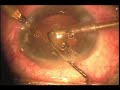 1.8 mm incision Phaco 1.8 mm incision Phaco