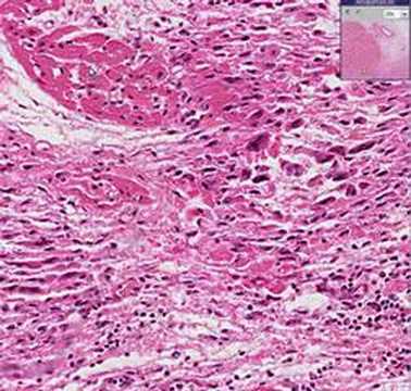 Histopathology Heart--Rheumatic fever