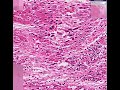 Histopathology Heart--Rheumatic fever