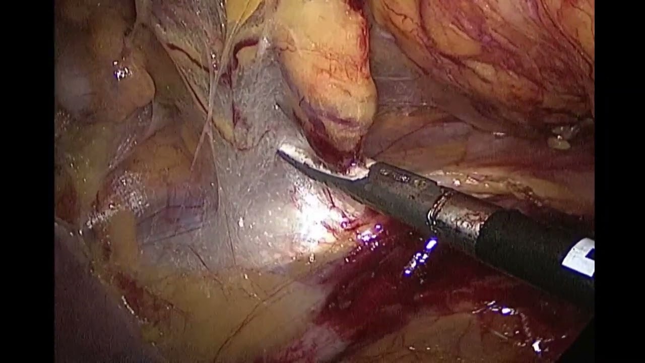 Cecum Cancer - Laparoscopic Right Hemicolectomy - Complete Mesocolic Excision