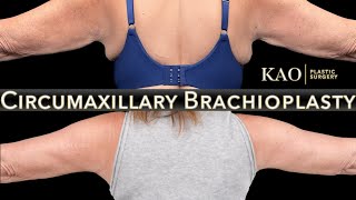 New Kao Plastic Surgery Innovation - Arm Lift - Circumaxillary Brachioplasty - Tightens Skin On Arms