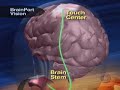 Blind Learn To See With Tongue (CBS News) Blind Learn To See With Tongue (CBS News)
