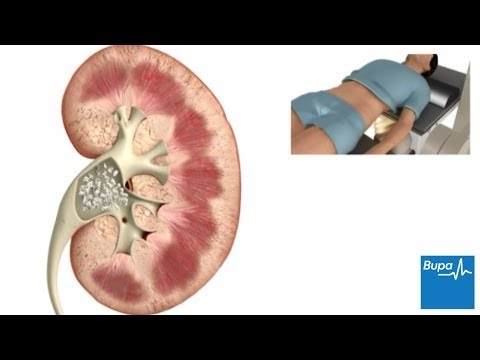 how to treat kidney stones