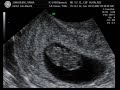 Life in the Womb I: 8 weeks ultrasound