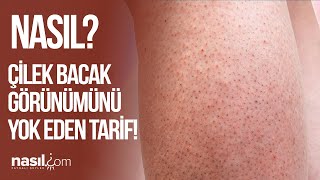 ÇİLEK BACAK GÖRÜNÜMÜNDEN KURTULUN! İŞTE P�