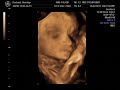 27 week 4 days 4d Ultrasound Scan - Baby Oliver