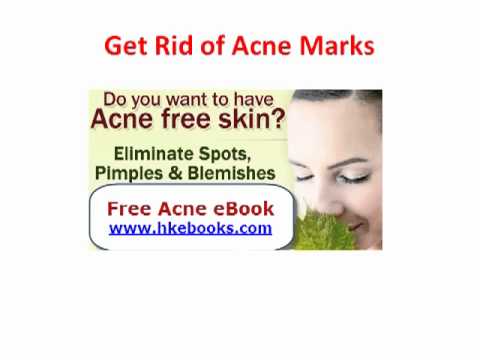 how to get rid of p acne