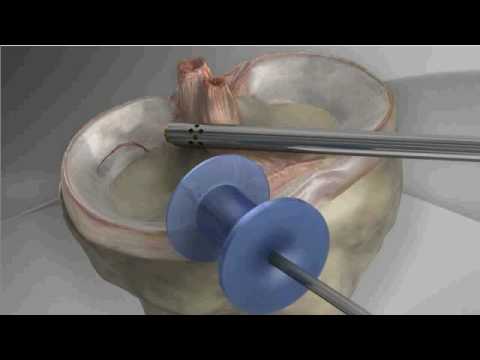 Artroscopia do joelho (cirurgia por vídeo)