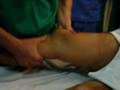 test lachman con cruzado anterior roto