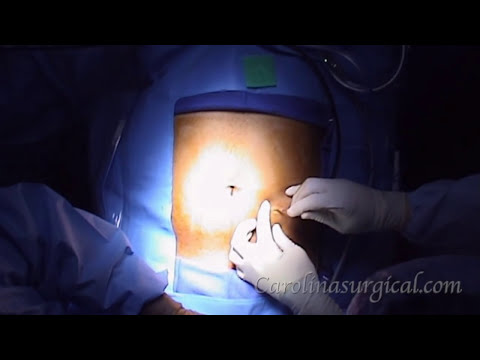 how to perform appendix surgery