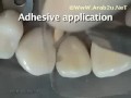 Class III Adhesive
