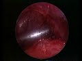 Laparosocpic Appendectomy Laparosocpic Appendectomy