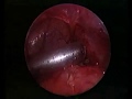 Laparosocpic Appendectomy