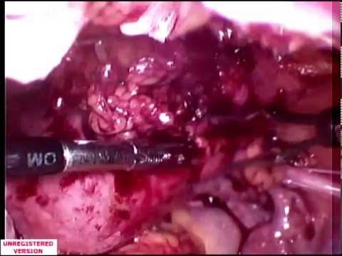 how to remove copper t