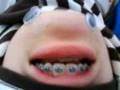 Bi chinface