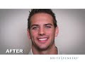 Teeth Whitening, Before and After