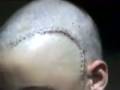 clival-chordoma-rare-tumour-brain-surgery.html
