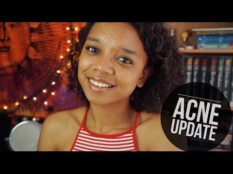 TheNewGirl007 ║ ACNE UPDATE #6! ☮
