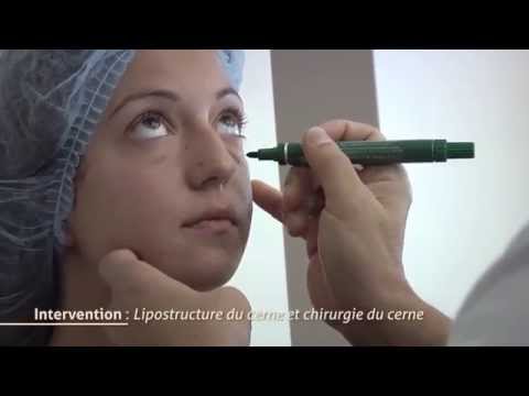 traitement poches yeux - Des cernes ? Pas seulement, parfois des cernes marqués sont accompagnés d'une poche sous les yeux. La lipostructure des cernes associée à l'ablation des poch...