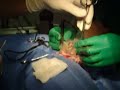 Dog Lumpectomy Dog Lumpectomy