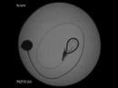 Inflating a gastric band (Swedish)