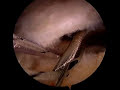 Arthroscopic Rotator Cuff Repair - Medium Supraspinatus Tear Arthroscopic Rotator Cuff Repair - Medium Supraspinatus Tear