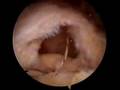 Arthroscopic Rotator Cuff Repair - Medium Supraspinatus Tear