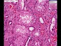 Histopathology Kidney--Arteriolosclerosis (hypertension), an