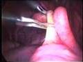Laparoscopic Appendectomy