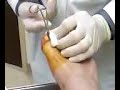 Ingrown Toenail (B.T.A.) Surgery