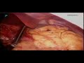 Bariatric Laparoscopic Surgery at SAIMS