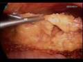 Bariatric Laparoscopic Surgery at SAIMS