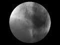 Ventricular Septal Defect seen on LV gram