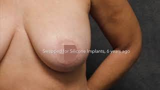 Silicone Implant Removal after 16 years with Dr. Kao's Signature Origami Breast Lift