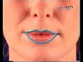 Restylane Faltenunterspritzung