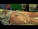 Femoral-Nerve-Cathet