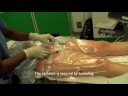 Femoral-Nerve-Cathet