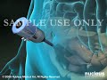 3D Medical Animation: Diagnostic Pelvic Laparoscopy