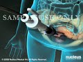 3D Medical Animation: Diagnostic Pelvic Laparoscopy